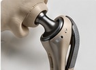 Arthroplasty