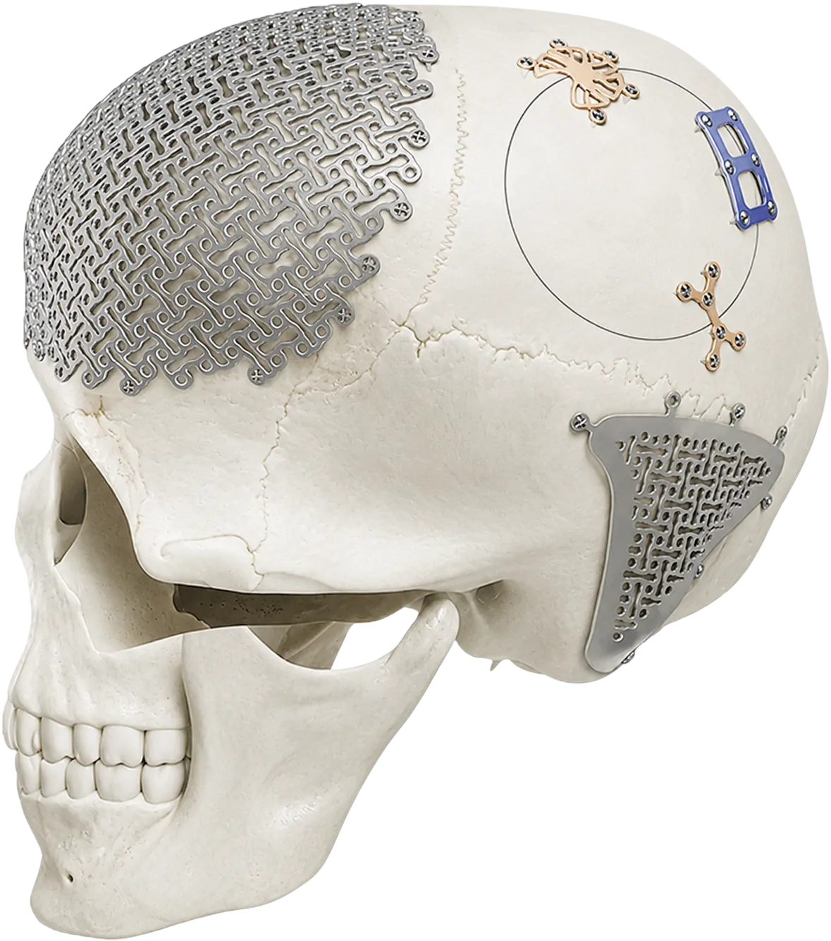 CMF-implants