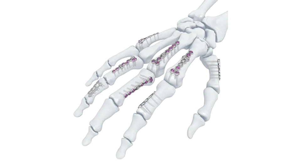 Trauma-implants