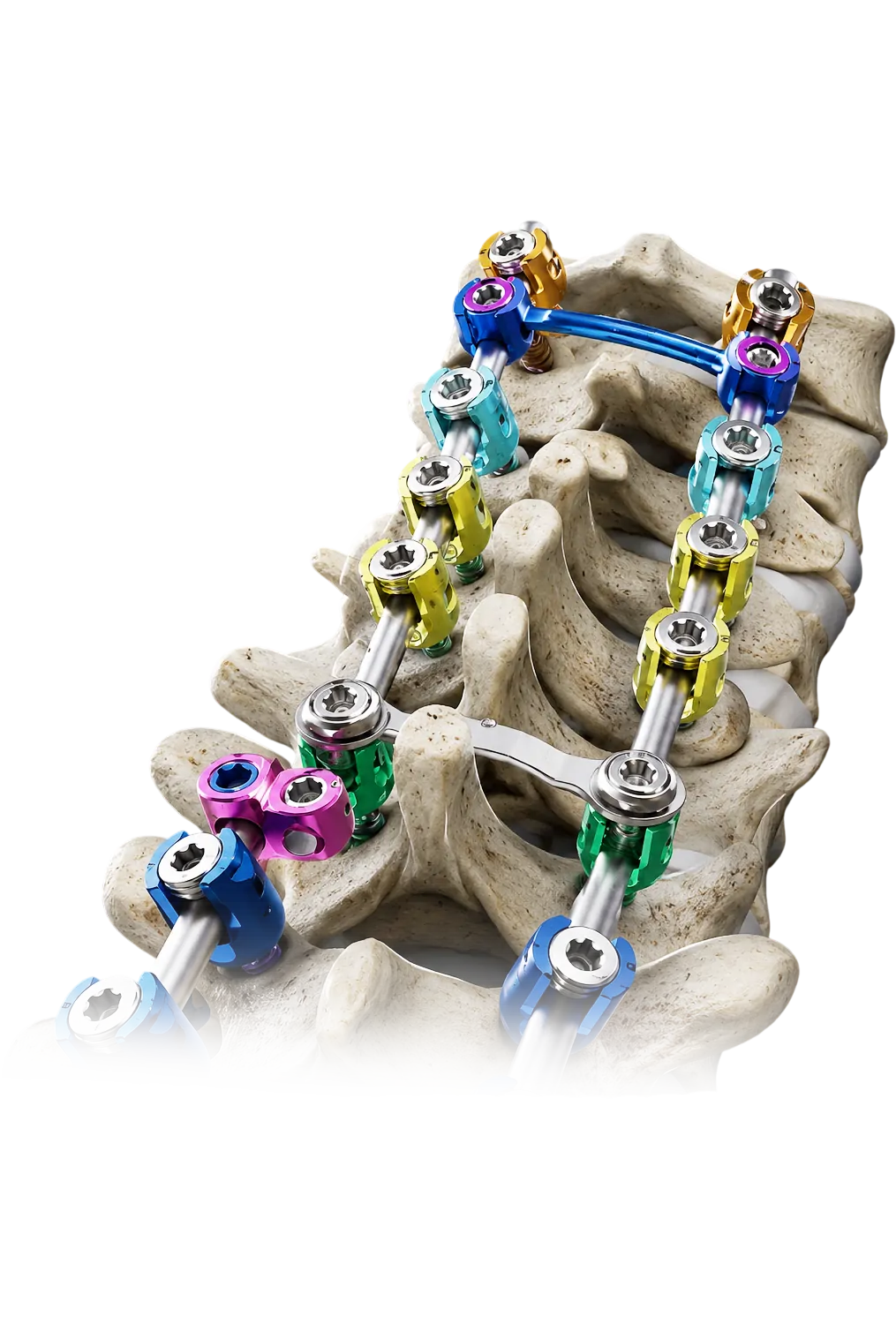 spine implants